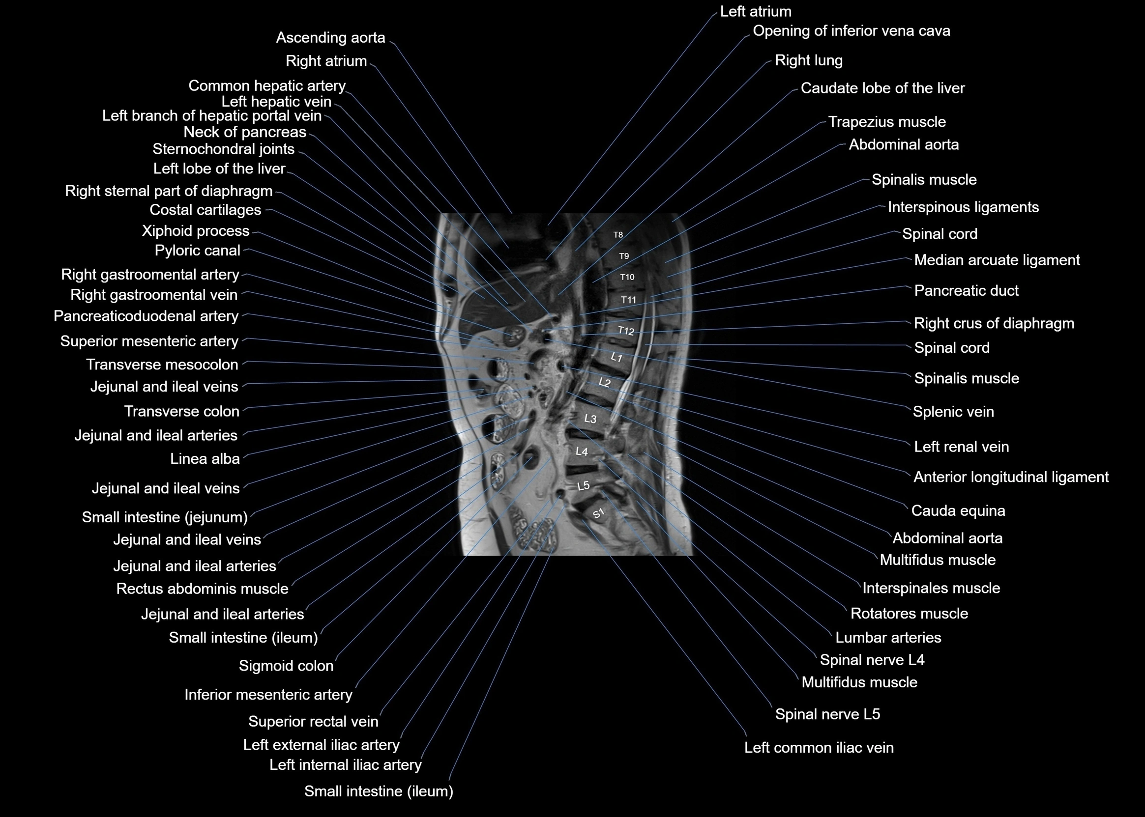 MRI abdomen sagittal cross sectional anatomy  radiology  image-img-00001-00038.webp